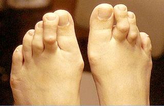 Highheels_hammertoes